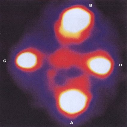 Einstein Cross. At the wavelength of redshifted hydrogen Lyman alpha emission there is connecting material between the quasar D and the central galaxy core